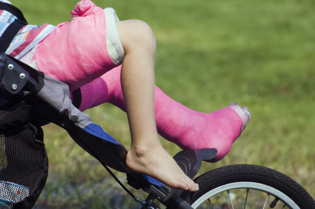 A girl rests on a stroller with a cast on her left leg from thigh to toe and on her right leg around her hip and upper thigh. Both are wrapped in bright pink gauze.