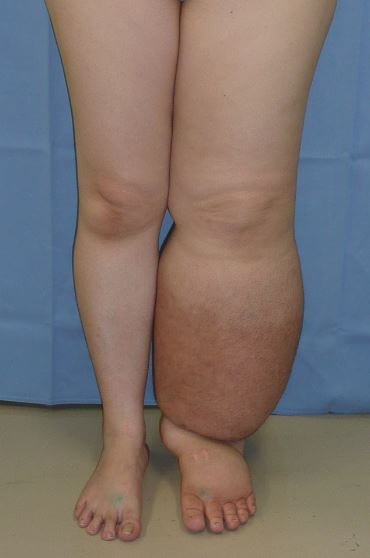 Image of a person suffering from lymphedema. Her right leg is not swollen, but the left is 3-4 times the size of the right.