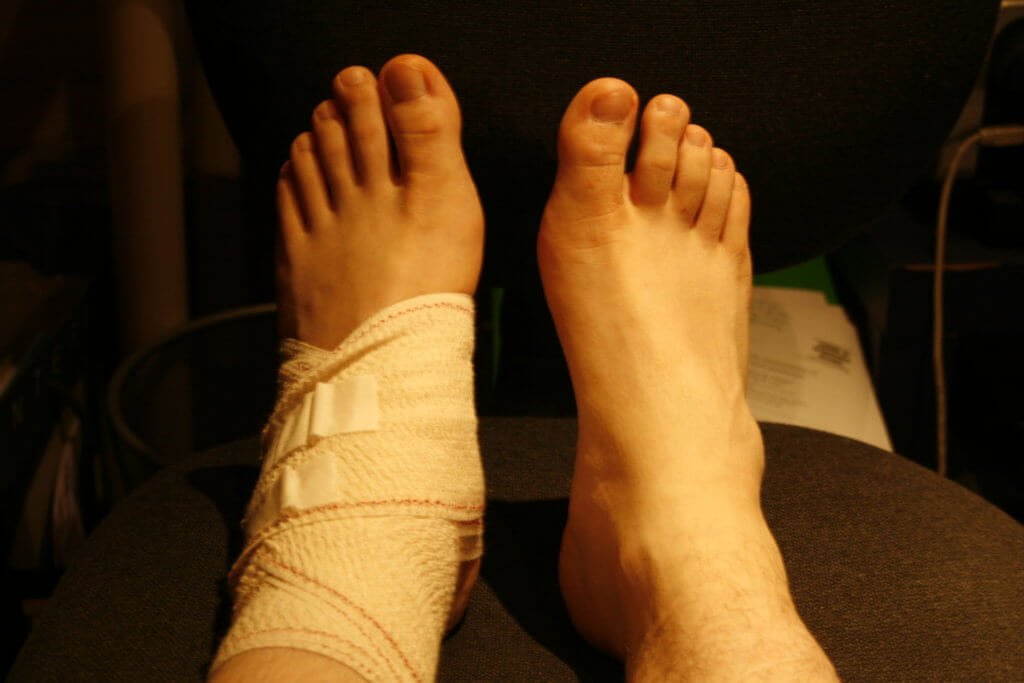 Photograph of a person's feet propped up on a bed. The left ankle is swollen and wrapped in an ACE bandage.
