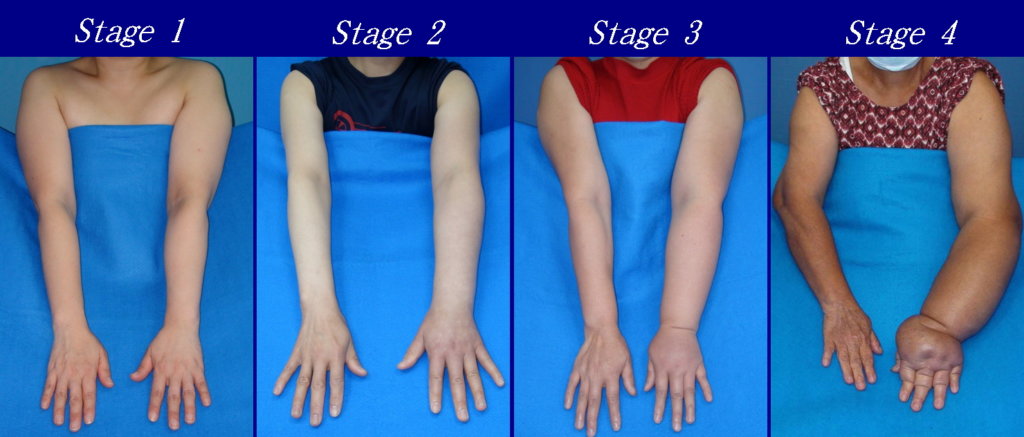 Four photographs of the various stages of lymphedema. Stage 1 and the least amount of swelling is on the left. Stage 4 and the most amount of swelling, which distorts the shape of the arm and fingers, is on the right.